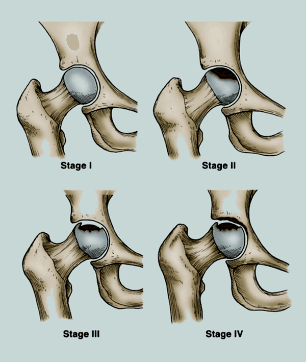 Боли в тазобедренных