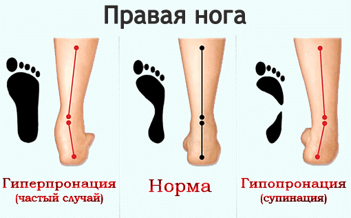 Нарушение анатомии стоп