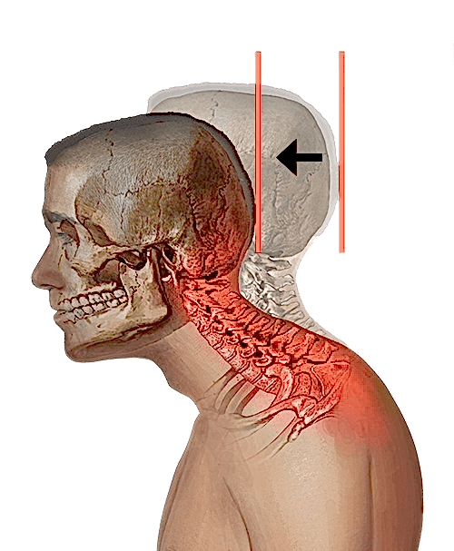 Компьютерная шея